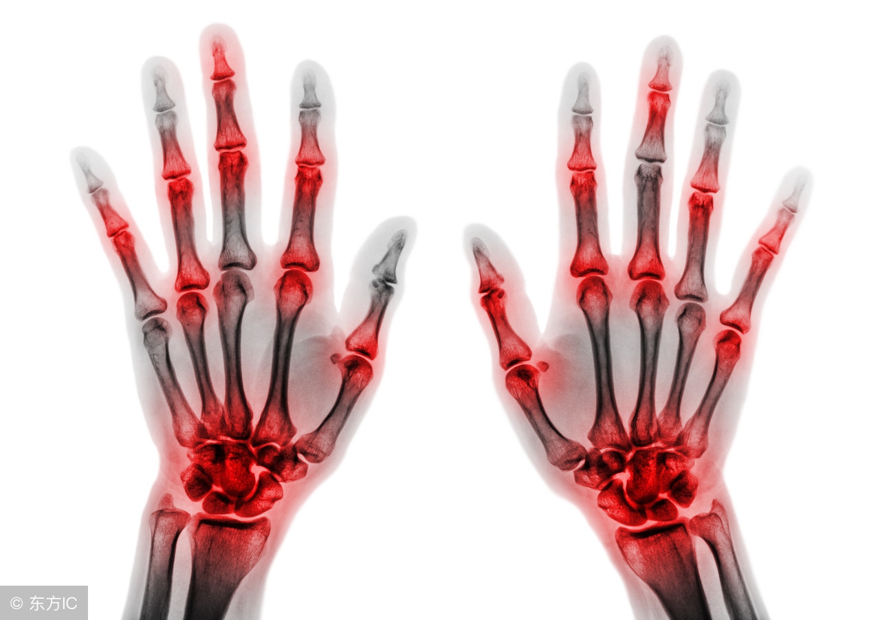 初期打生物制剂能治类风湿吗,类风湿打强克针能治好吗