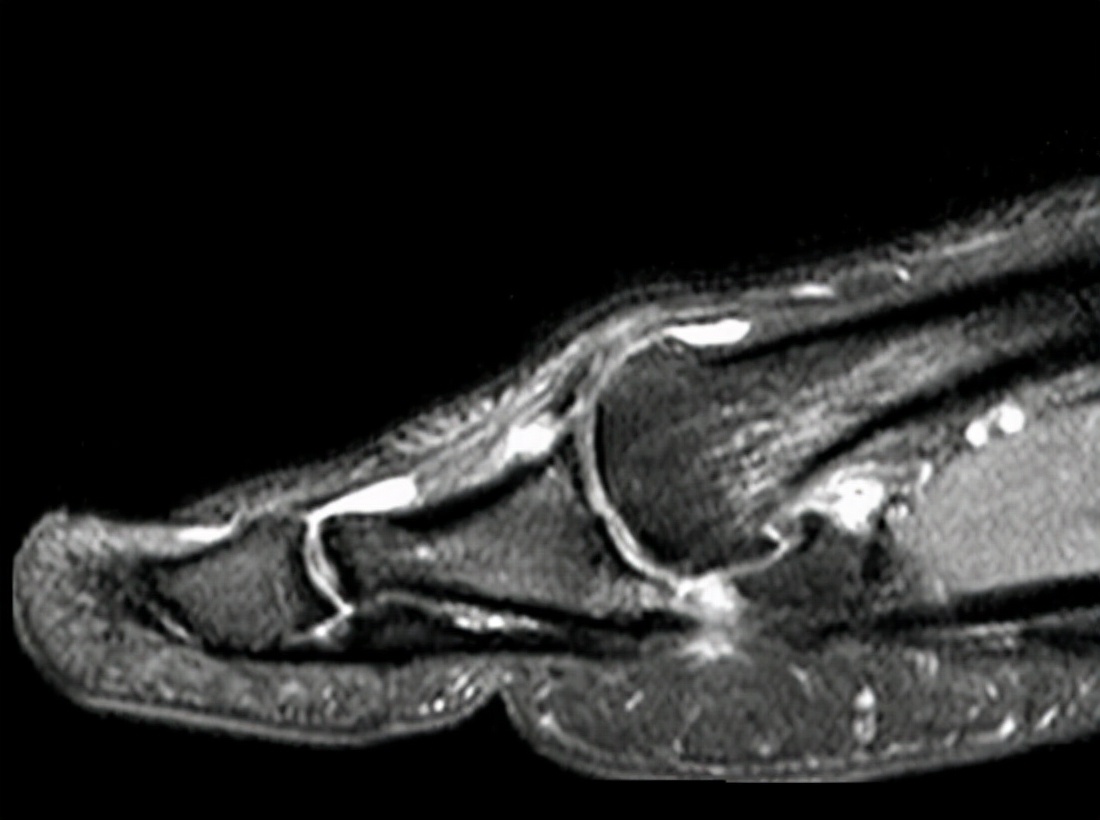 草地趾的症状,草地趾怎么康复