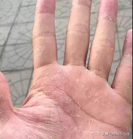 手上手臂起小水泡很痒是怎么回事,手上小水泡抓破了烂了一大片