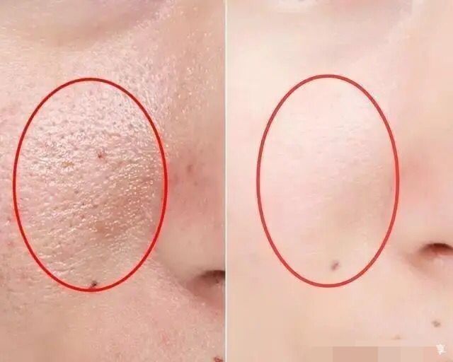 王鸥谈打了瘦脸针,王鸥打过瘦脸针吗