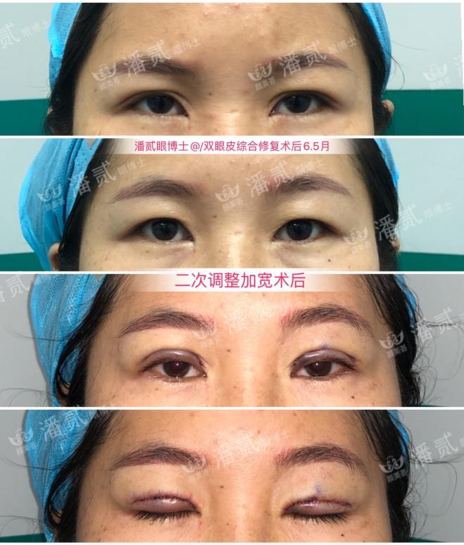 双眼皮太深显老怎么修复,双眼皮失败后修窄