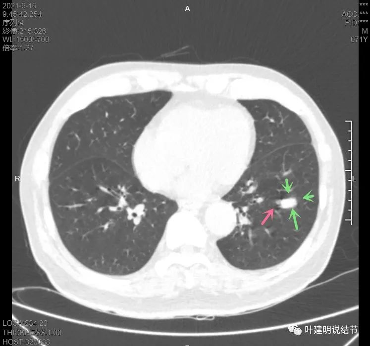 肺上有实性结节6mmx5mm是什么原因,肺上有1.7x1.8的实性结节该怎么办