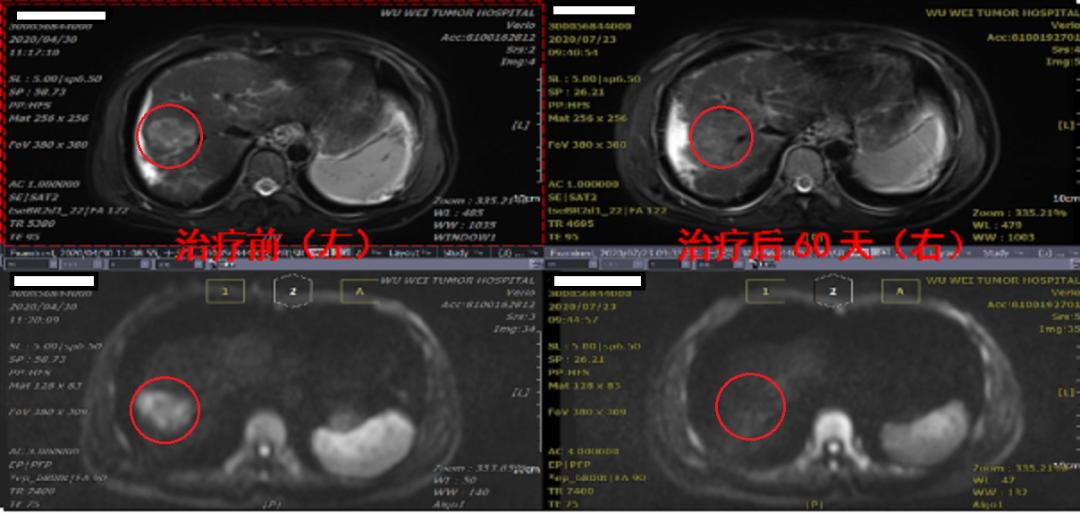 重离子加速器治疗癌症,癌症治疗最新成果肝癌