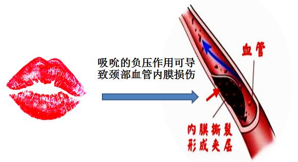 一个吻痕引起的致命性脑梗死事件，医生为你图说其中的机制