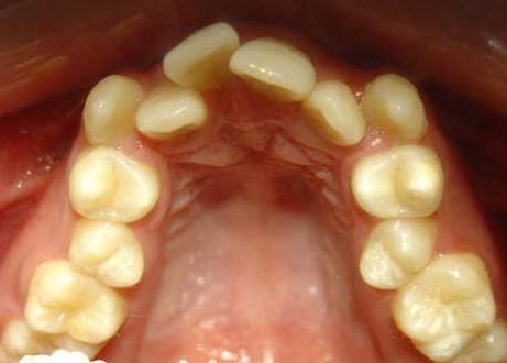 小朋友换牙歪歪扭扭,小孩换牙都长得歪歪扭扭怎么办