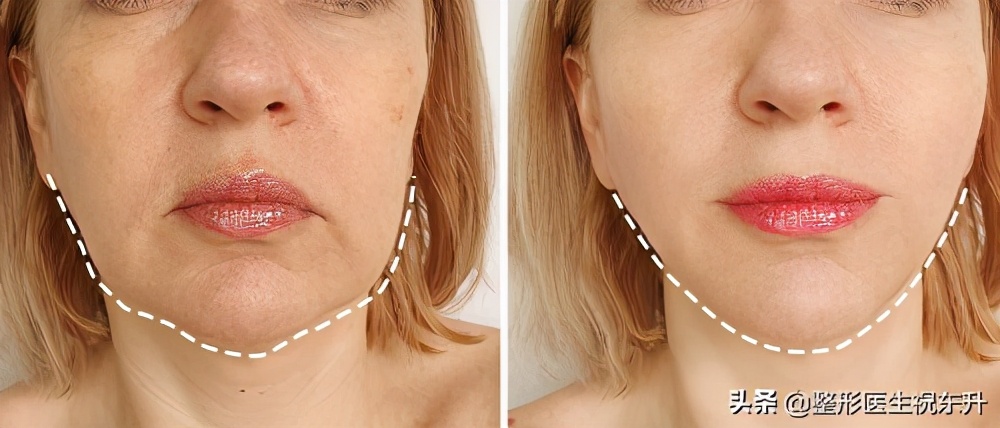 嘴角两旁的嘟嘟肉怎么去除,如何改善嘴角嘟嘟肉
