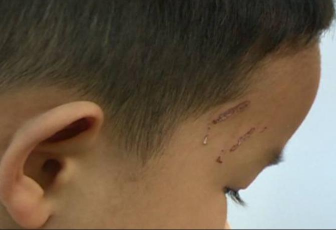 儿童被鸡抓伤长出鸡脚,小孩被鸡抓伤会留疤吗