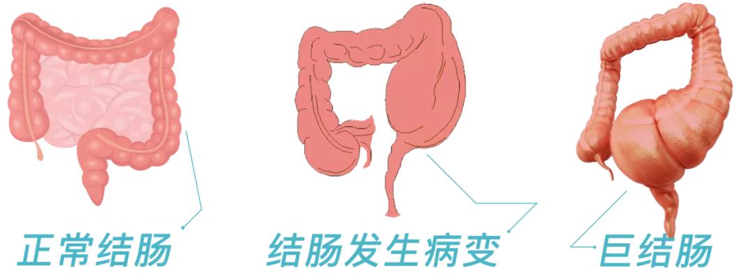 医疗科普便秘视频,科普便秘的预防