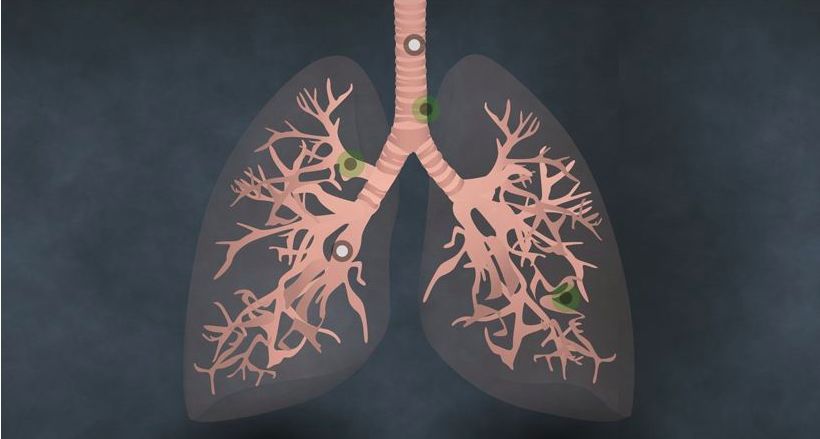 三大症状出现慢阻肺必须治,30岁了什么都没有但是有病