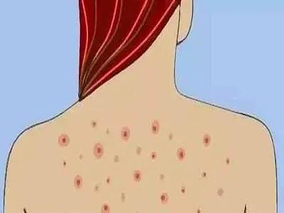 刮体毛会变好运吗,刮体毛导致体毛旺盛怎么办