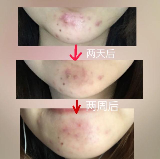 去角质的10个小常识,如何判断要不要去角质呢