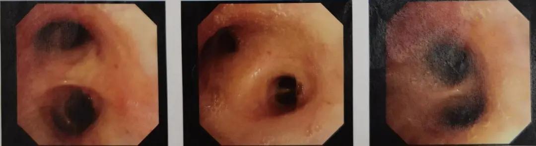 双肺多发结节，反复检查为何诊断重点成「盲区」？