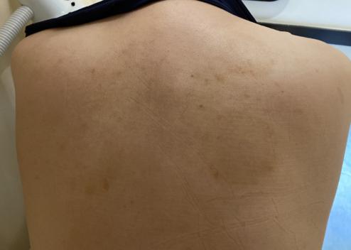 玫瑰糠疹如何治疗和注意事项,花斑糠疹和玫瑰糠疹有什么区别