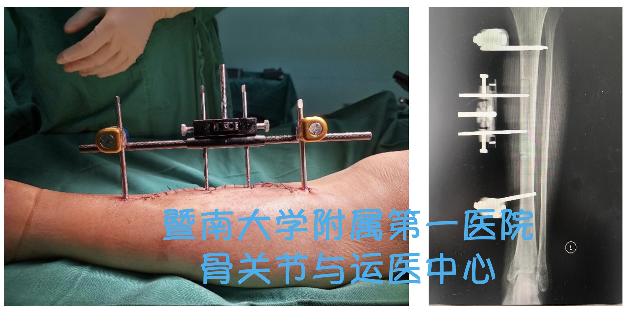 糖尿病足截肢后怎么长肉快,糖尿病足不截肢的最新疗法