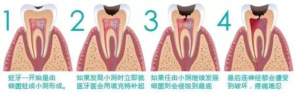 牙疼的时候能抽牙神经吗,牙疼为啥要拔神经
