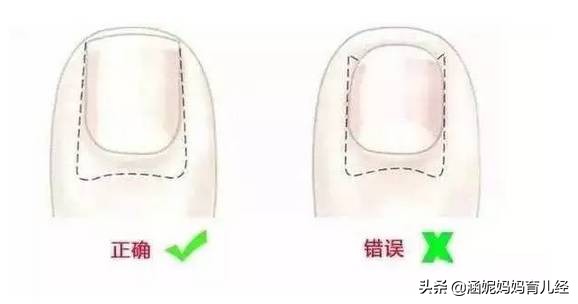 孩子脚趾红肿怎么回事不是甲沟炎,儿童脚趾甲甲沟炎红肿疼怎么处理