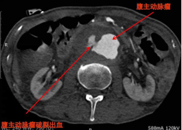 腹痛急剧怎么办？当然是快速准确诊断病因最重要，否则没法治疗