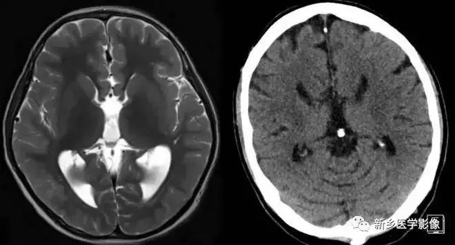 影像学脑室扩大,脑室显大怎么理解