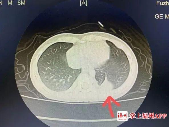 小孩咳嗽发烧已经3天,5个月宝宝咳嗽反复发烧38.5