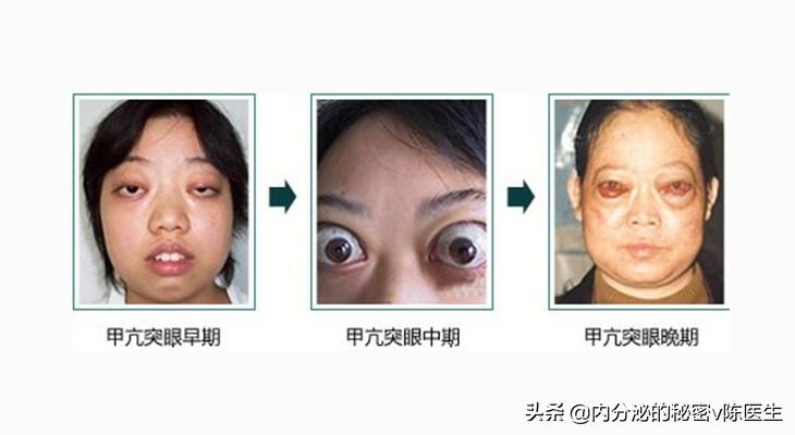 甲状腺相关性眼病,甲状腺相关性眼病可包括