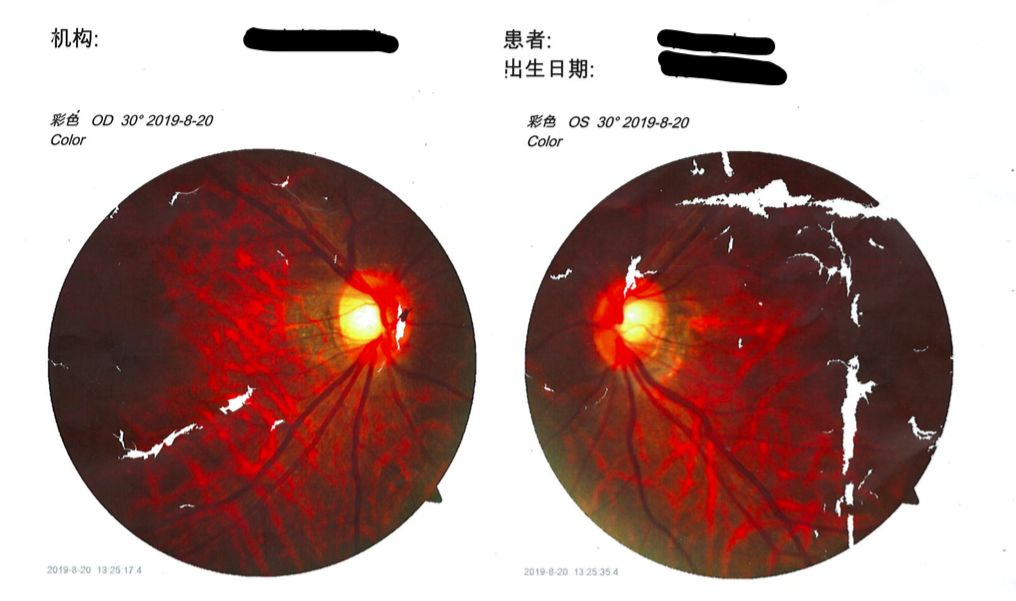 左眼突然看不见了一会儿又好了,左眼突然看不见睡起来好了