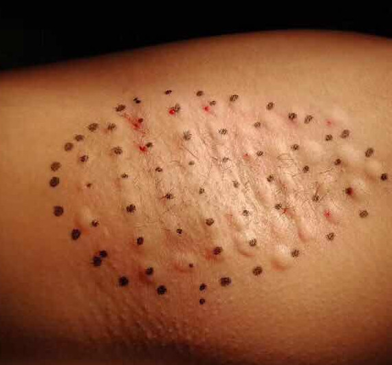 肉毒素打鱼尾纹范围大注射点图解,鱼尾纹肉毒素的危害和后遗症