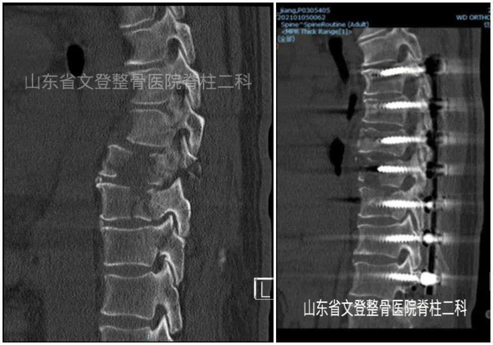 文登整骨医院治疗截瘫,山东文登整骨医院治疗怎么样