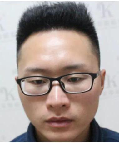 m型脱发和o型脱发区别,m型脱发可能是肾虚型脱发吗