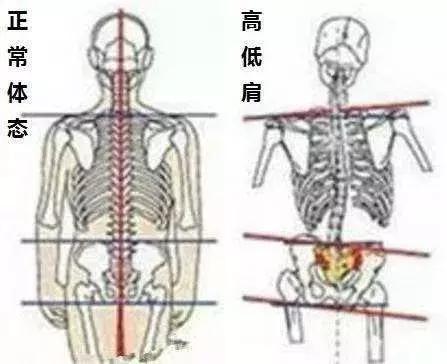 纠正不良姿势,不良体态矫正最佳方法