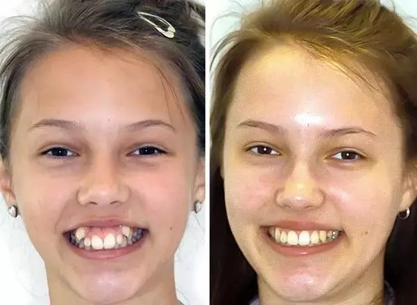 牙齿科普整牙堪比整形,整牙堪比换脸真的假的