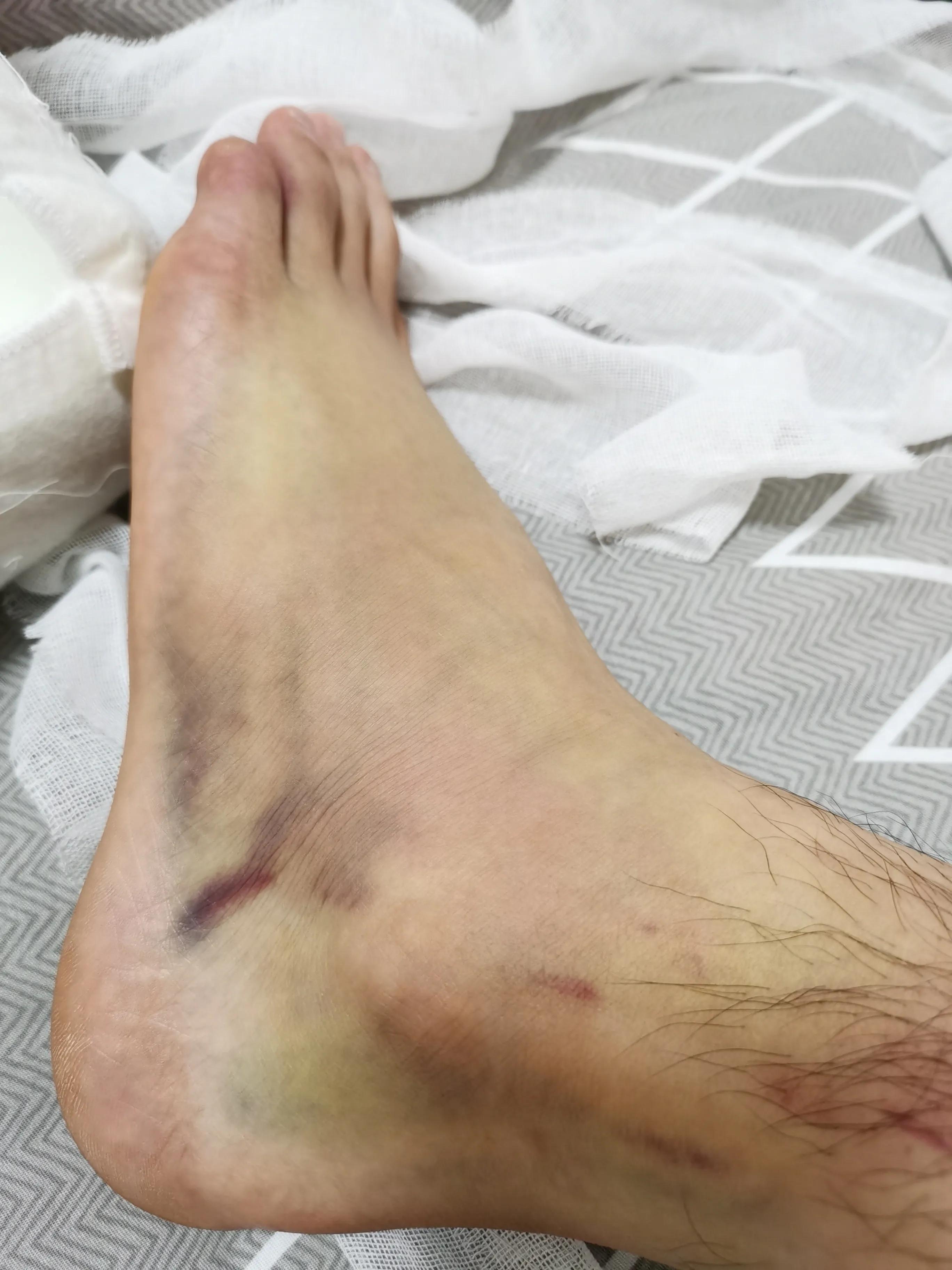 第五跖骨基底部骨折60天能走路吗,第五跖骨基底部骨折60天能脱拐吗