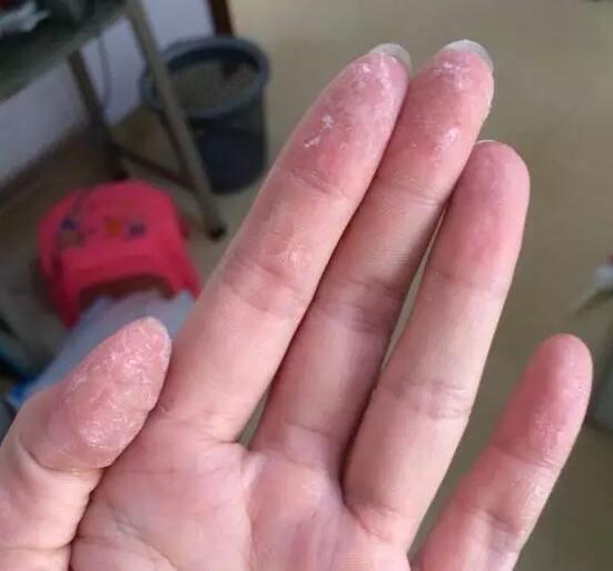 被502胶水粘住的指甲怎么解除,502胶水把手黏住了然后怎么洗掉