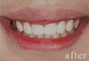 牙齿特别黄洗牙都没用怎么美白,什么牙膏美白牙齿去黄最好