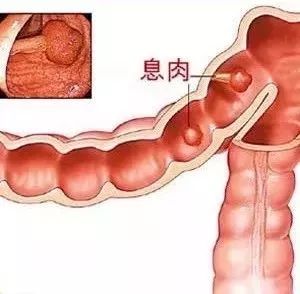 花10块钱就有可能发现的癌症，很多人却不愿意做