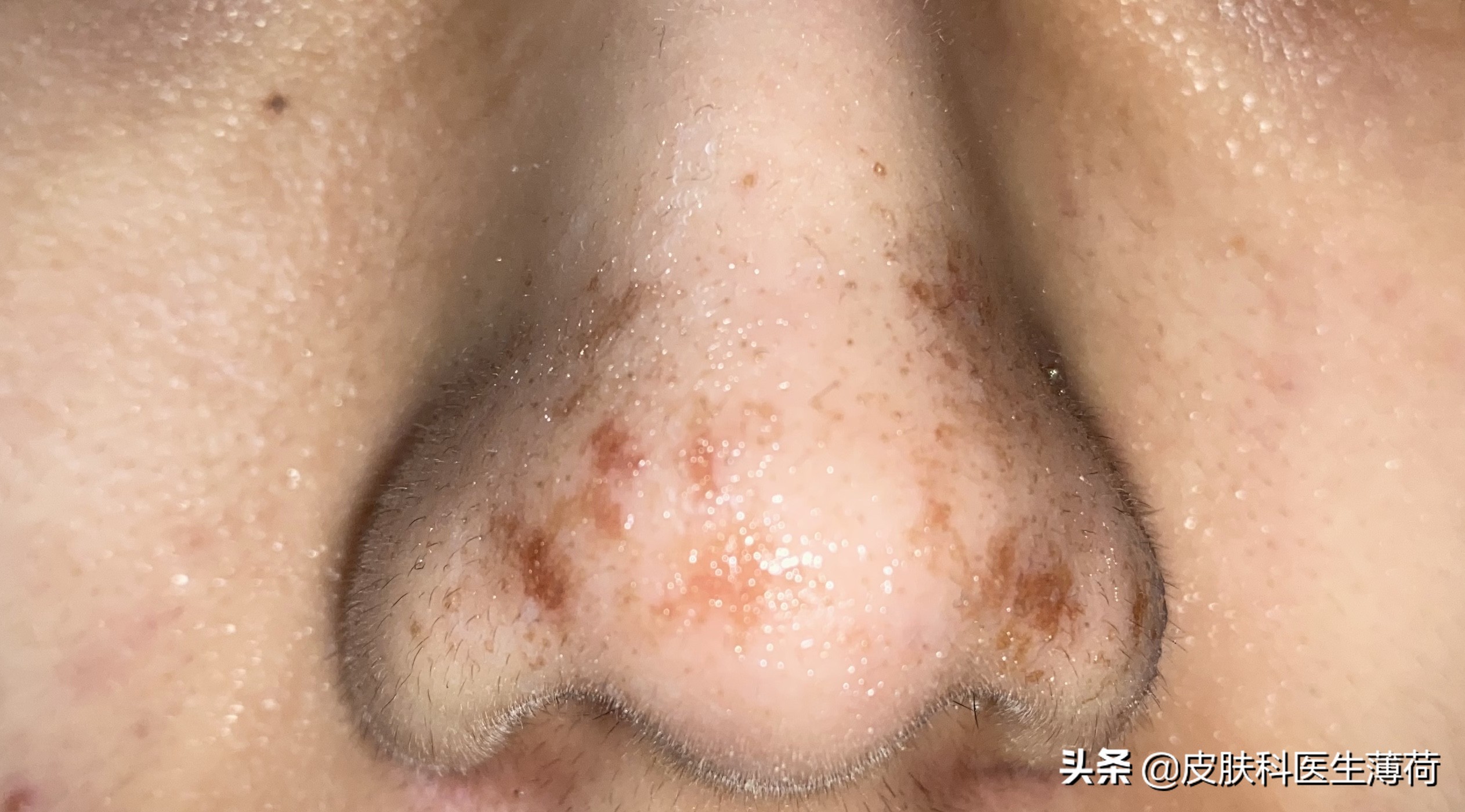 果酸换肤医生讲解,医生不会告诉你的秘密水杨酸