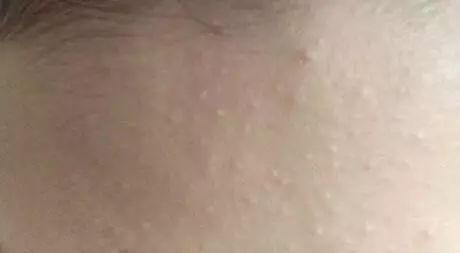 避免痘痘的四个误区,只需四个步骤解决痘痘问题