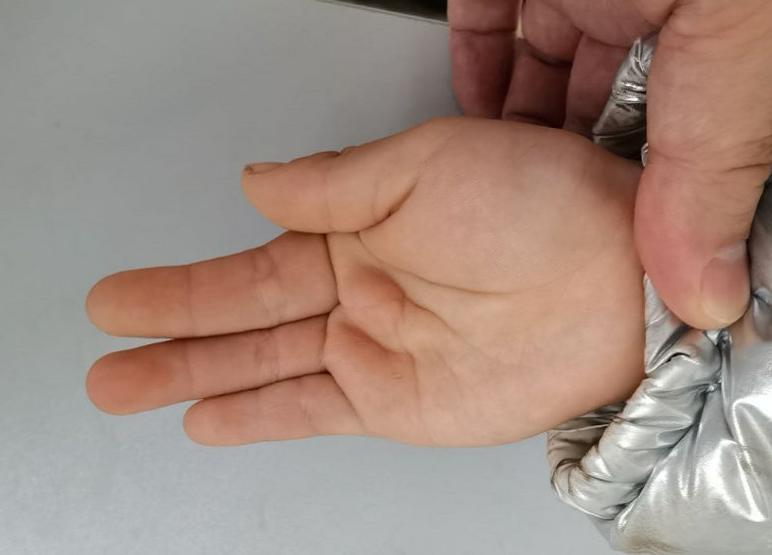 并指畸形免植皮案例,并指畸形