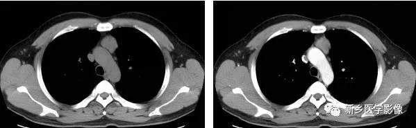 前上纵隔高密度影考虑胸腺未退化,肺纵隔胸腺结节12mm看什么科