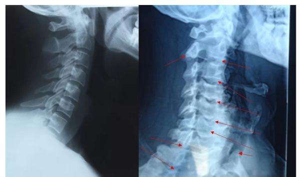 颈椎长骨刺该怎么治疗呢,颈椎骨刺有什么说法