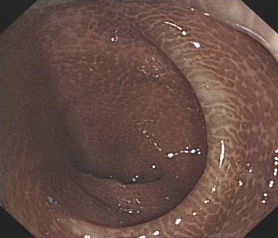 便秘不是小事,便秘不是大问题不需要太过紧张