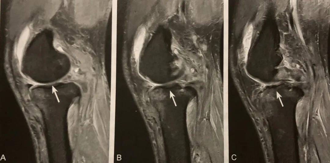 膝关节常见损伤的检查方法,膝关节损伤病例图片