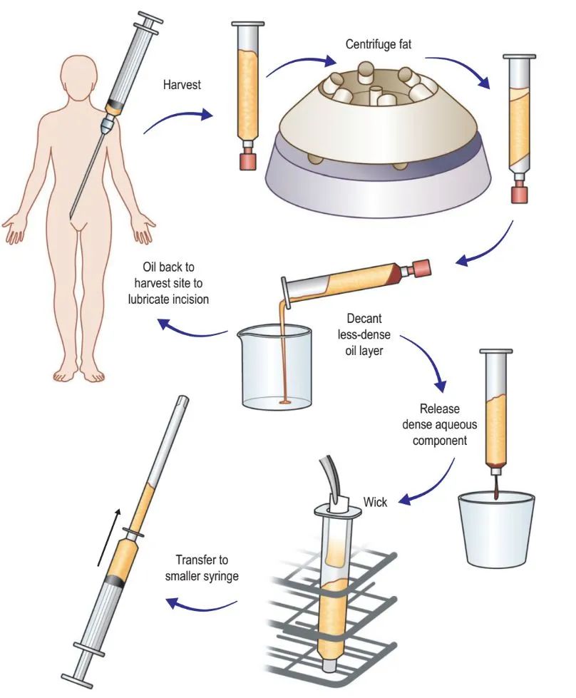 娄艺潇填充脂肪前后对比,娄艺潇填充前后对比