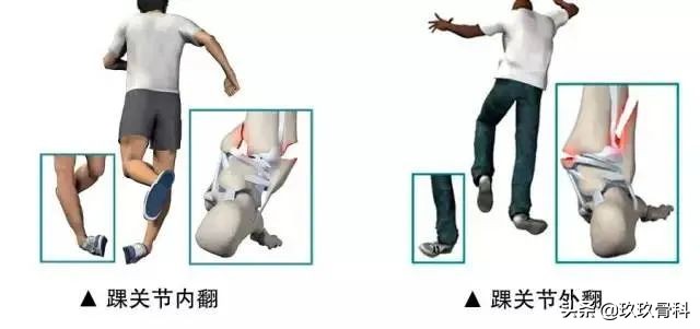 习惯性脚踝扭伤3年怎么治疗,习惯性扭伤脚踝隐隐作痛