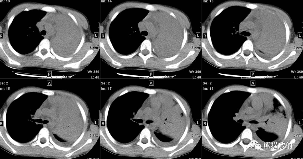 x线诊断边界模糊,x线诊断有误区吗