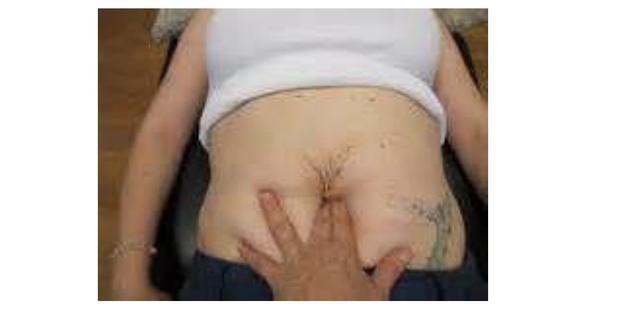 老师:孩子都大了,腹部还松弛下垂像刚出月子,有办法恢复吗?有