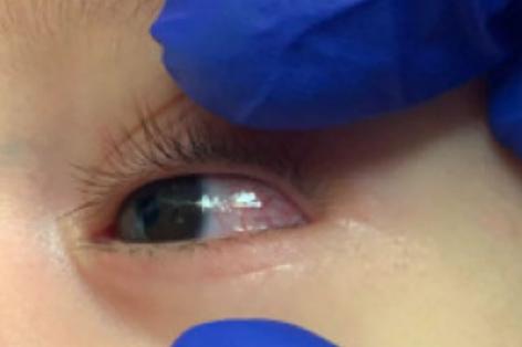 高烧引起的死亡病例,高烧致死的儿童