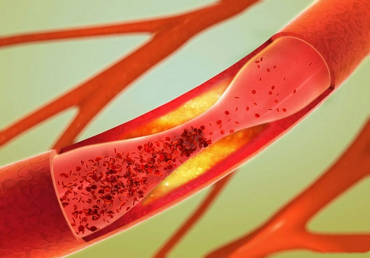 牙龈夜里老出血会得脑梗吗,牙龈出血与心脑血管有关系吗