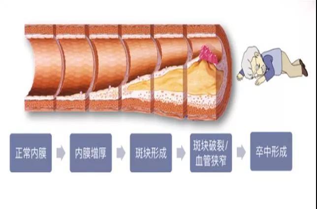 查颈动脉斑块挂什么科,颈动脉斑块的治疗方法