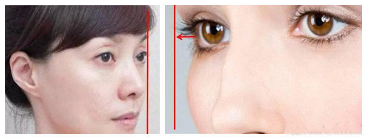 双眼皮怎么才能做到闭眼无痕,双眼皮想要更宽一点