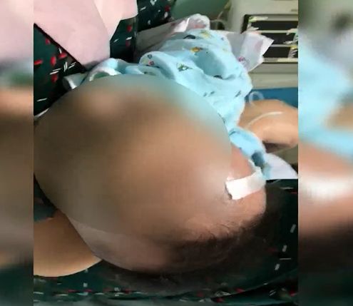 婴儿腰椎穿刺两次没成功,宝宝腰穿刺失败